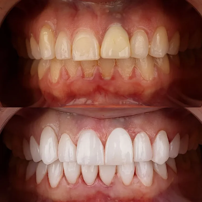 Smile makeover result at Hollywood Perfect Smile in Hollywood, FL