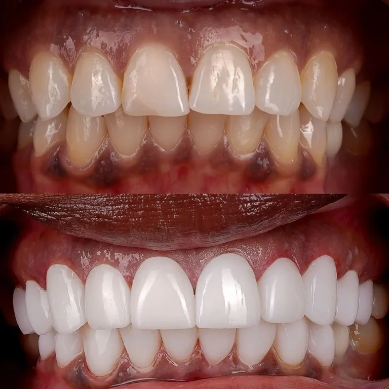 Smile makeover result at Hollywood Perfect Smile in Hollywood, FL
