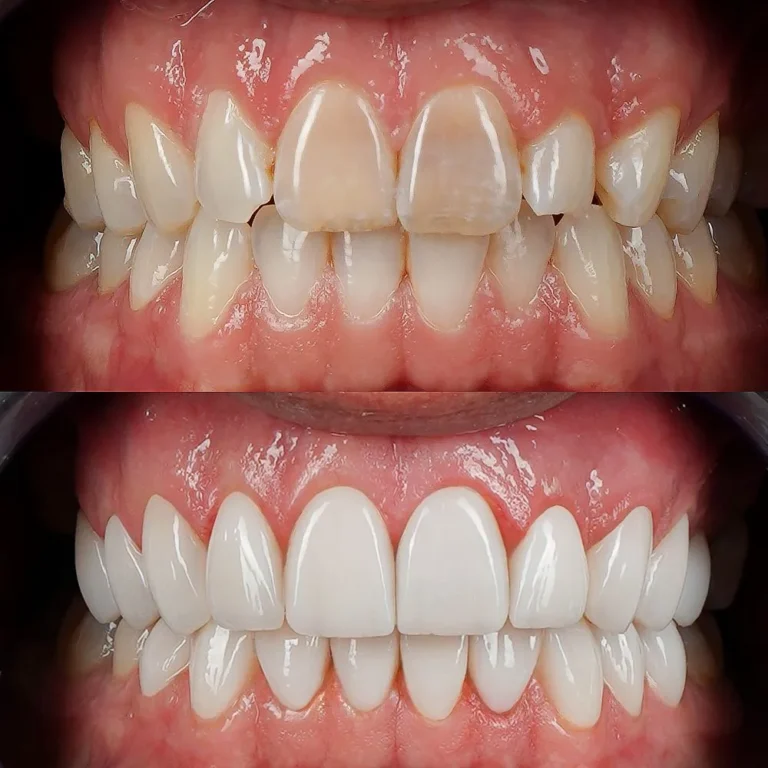 Smile makeover result at Hollywood Perfect Smile in Hollywood, FL