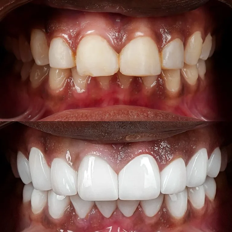 Smile makeover result at Hollywood Perfect Smile in Hollywood, FL