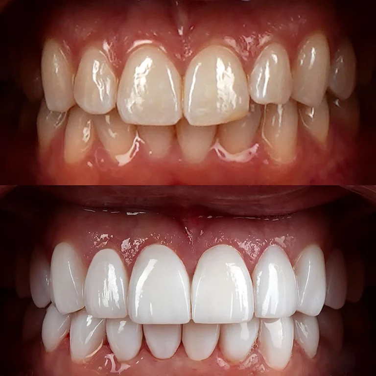 Smile makeover result at Hollywood Perfect Smile in Hollywood, FL