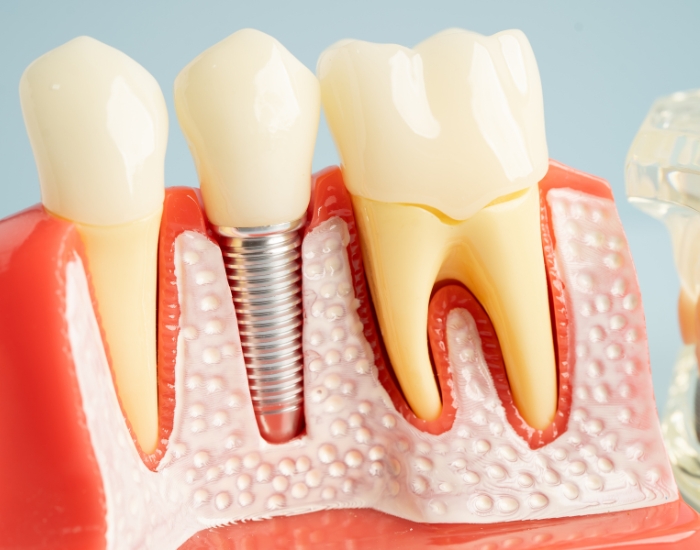 The Pros and Cons of Dental Implants in Hollywood, FL
