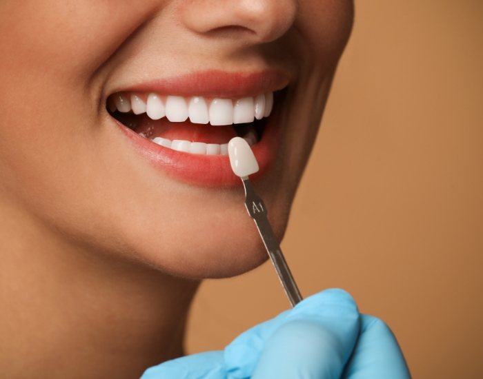 10 Pasos para Colocarte Carillas Dentales en Hollywood, Florida