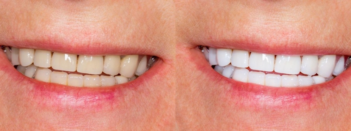veneer-before-and-after (1) veneer in miami
