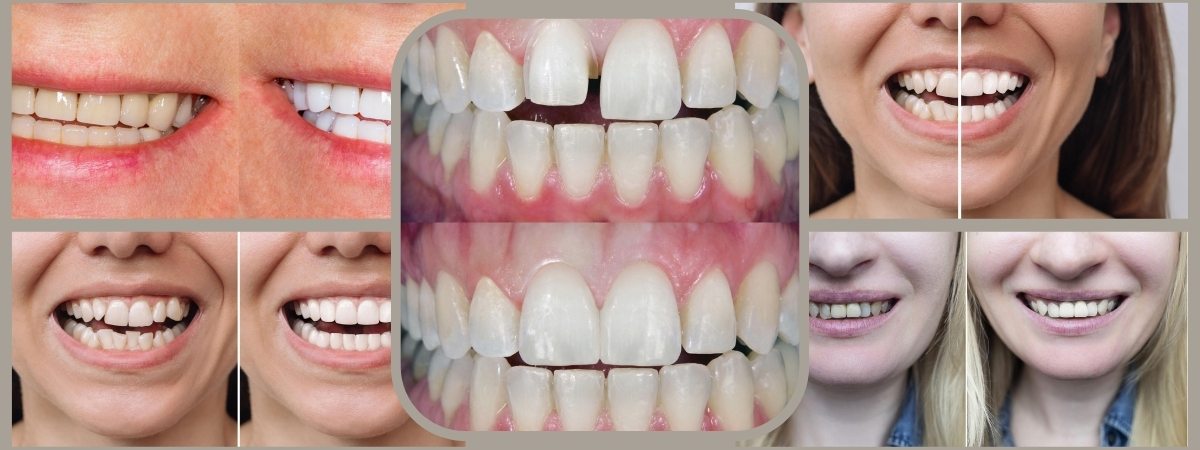 veneer-before-and-after veneer before and after today