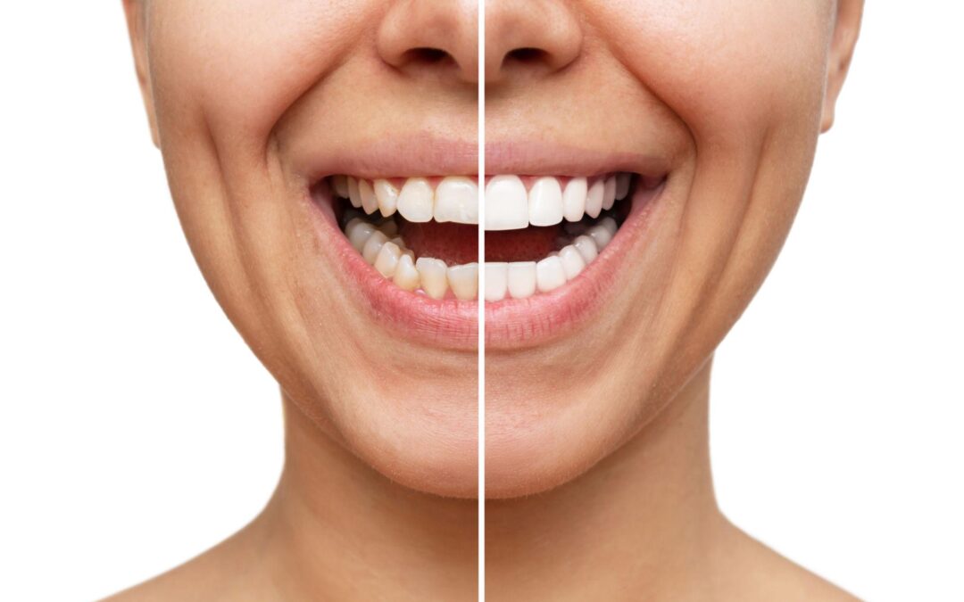 Veneers in Dentistry: How It Transforms Your Smile