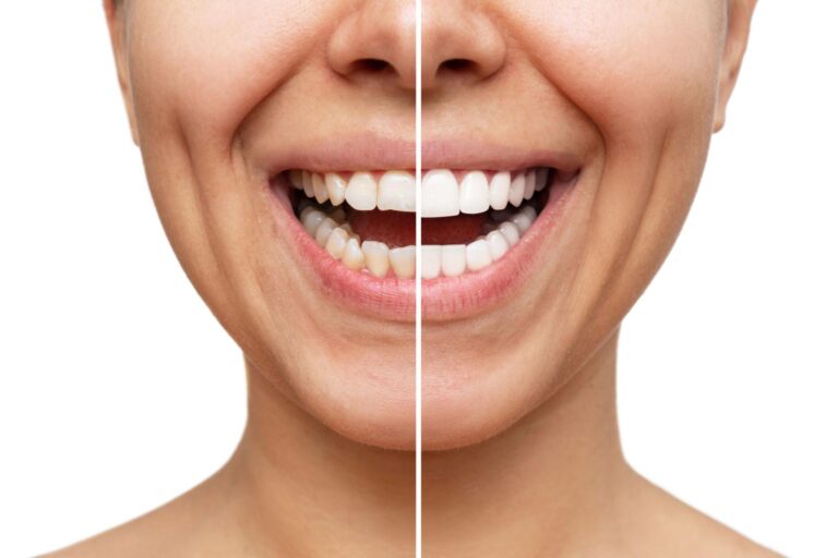 veneer in tooth