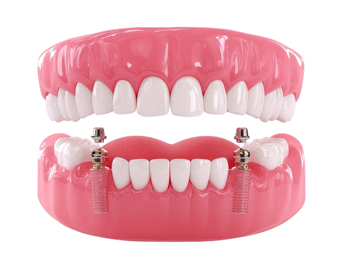 Dental implant safety concept showing titanium implant in jawbone with dentist consultation