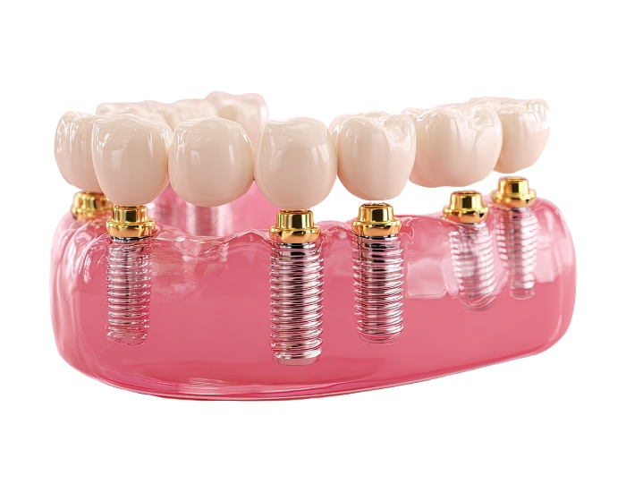 Dental implant diagram showing titanium post in jawbone with crown on top