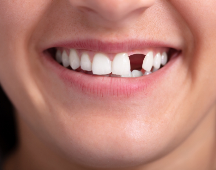 What Is the Best Option for Missing Teeth in 2026? Implants vs Bridges vs Dentures