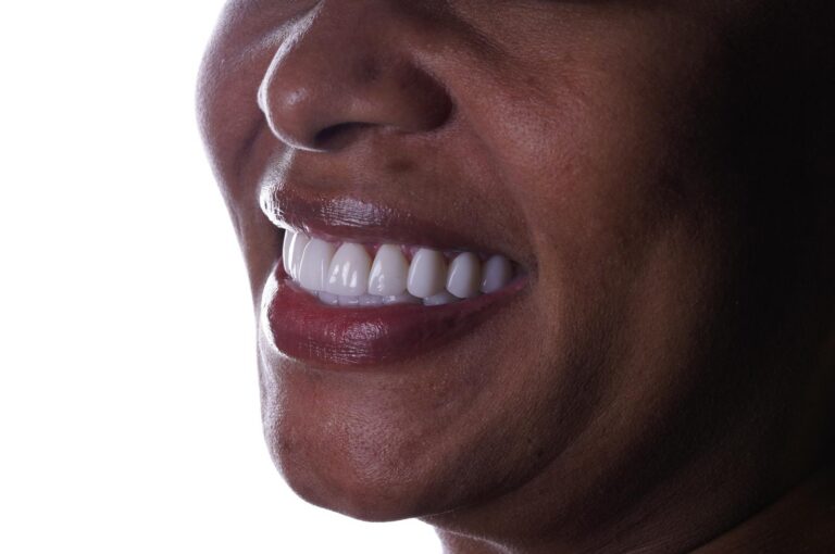 Smile design result at Hollywood Perfect Smile